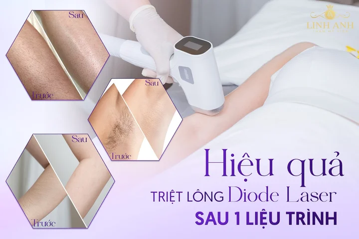 Thẩm mỹ viện Linh Anh - Địa chỉ triệt l&ocirc;ng Diode Laser uy t&iacute;n tại Quận 10