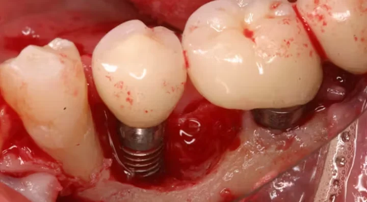 Nên kiêng rượu bia trong bao lâu trước khi cấy ghép Implant?