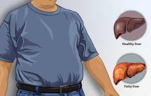 Gan Nhiễm Mỡ Độ 3 Vì Nước Cam Ép: Ba Cấp Độ, Thuốc Mới, Nên Làm Gì